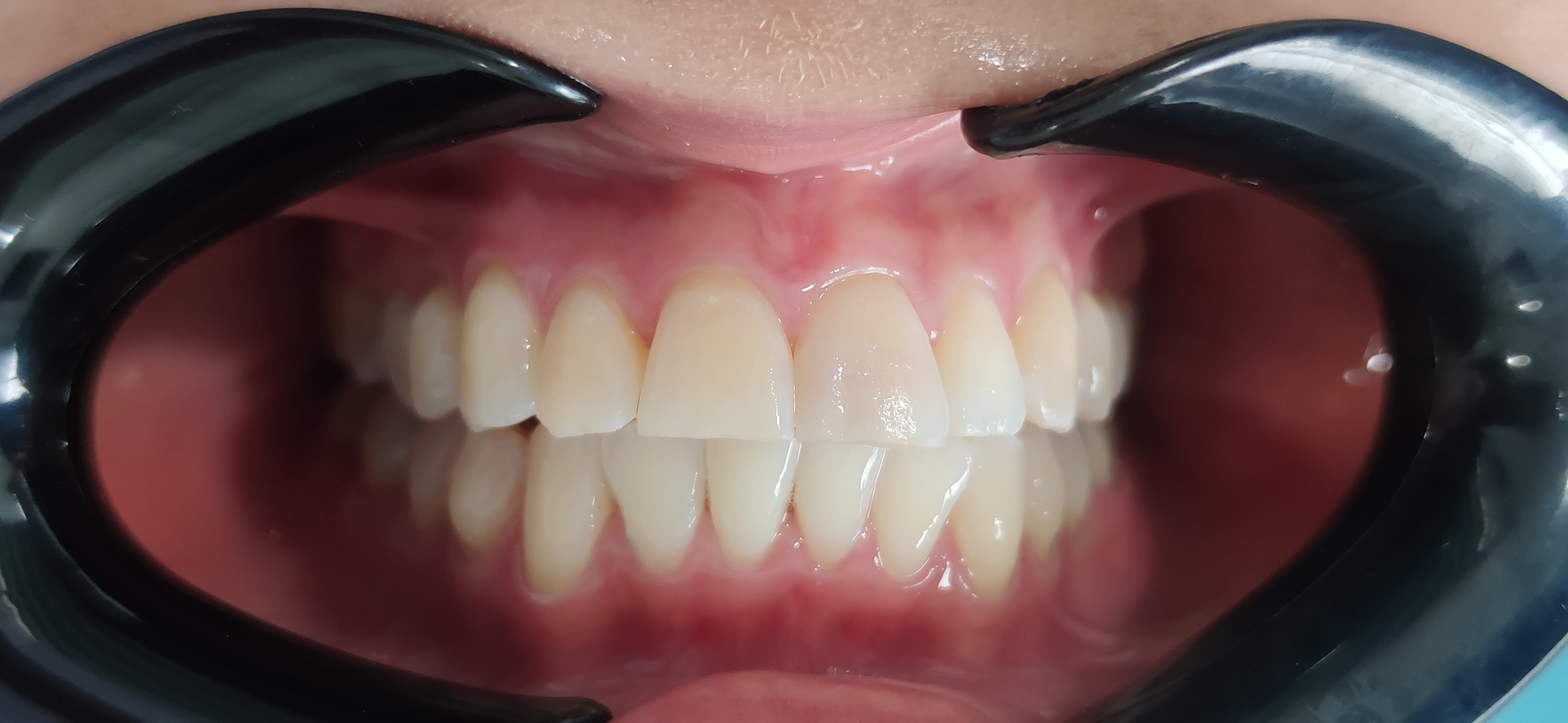 Dientes del mismo paciente después del blanqueamiento realizado en ALDental.