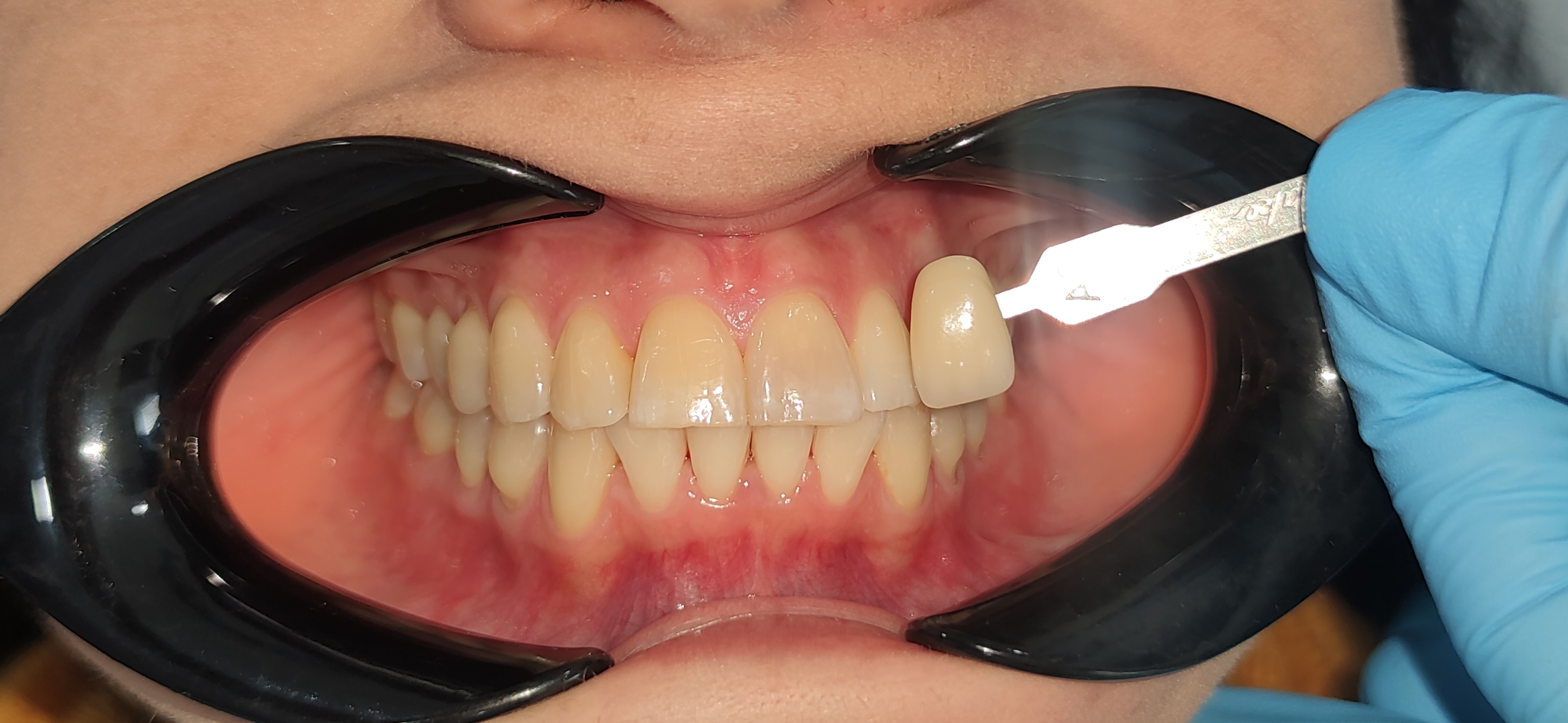 Dientes del paciente antes del blanqueamiento, junto a una muestra de color dental.